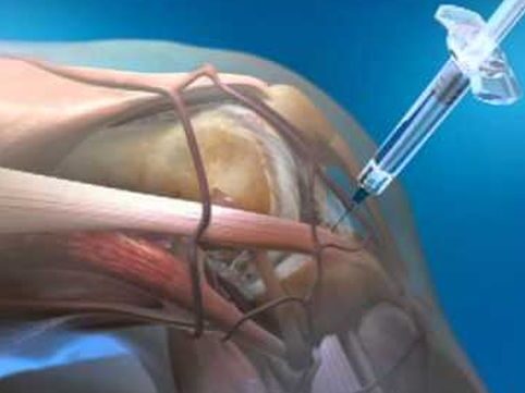 Infiltratii intraarticulare